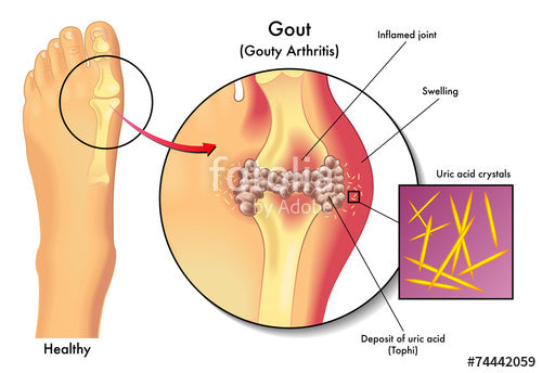 What Causes High Uric Acid Levels In Blood? Quick Pointers For Gout Patients
