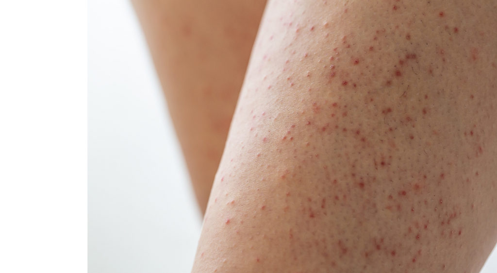Understanding and Managing Keratosis Pilaris : Ayurvedic Insights