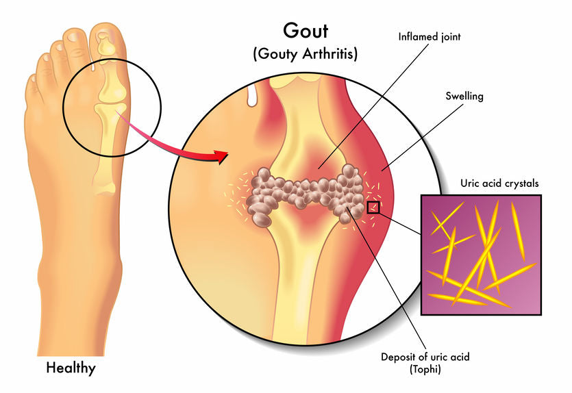 How To Manage the Symptoms of Gout with the Help of Natural Remedies?