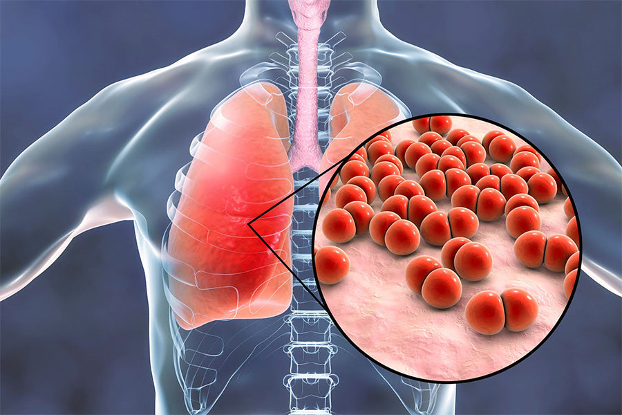Can Bronchitis Turn Into Pneumonia?