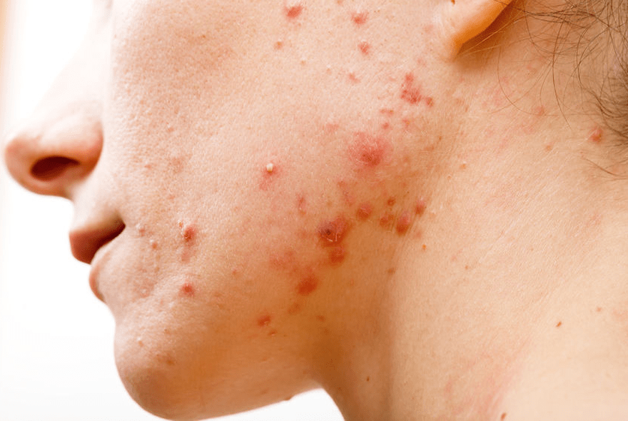 Ayurvedic Treatment for Skin Diseases