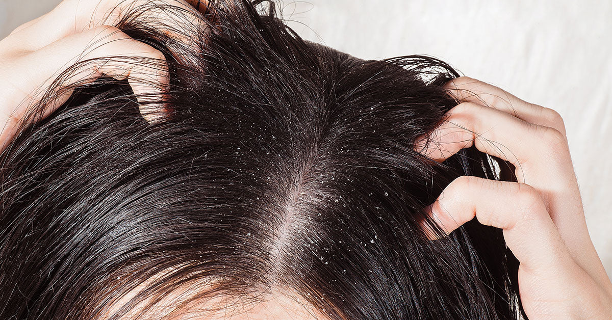 Ayurvedic oil for dandruff control : 4 things to know