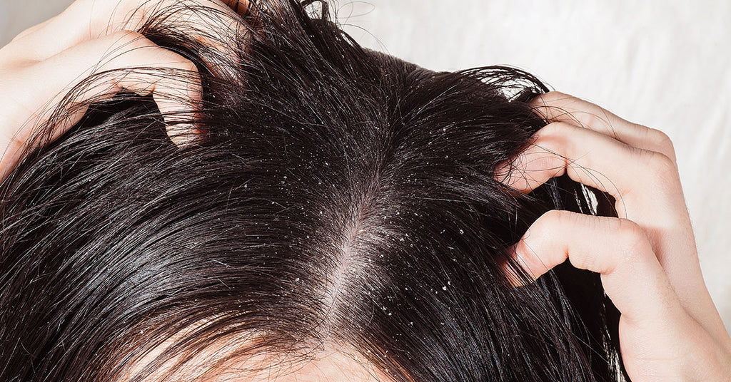 Ayurvedic oil for dandruff control : 4 things to know