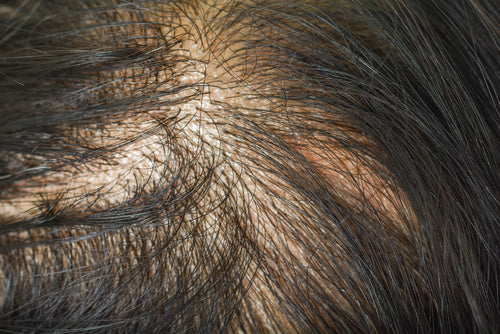 Reasons Why You're Losing Your Hair