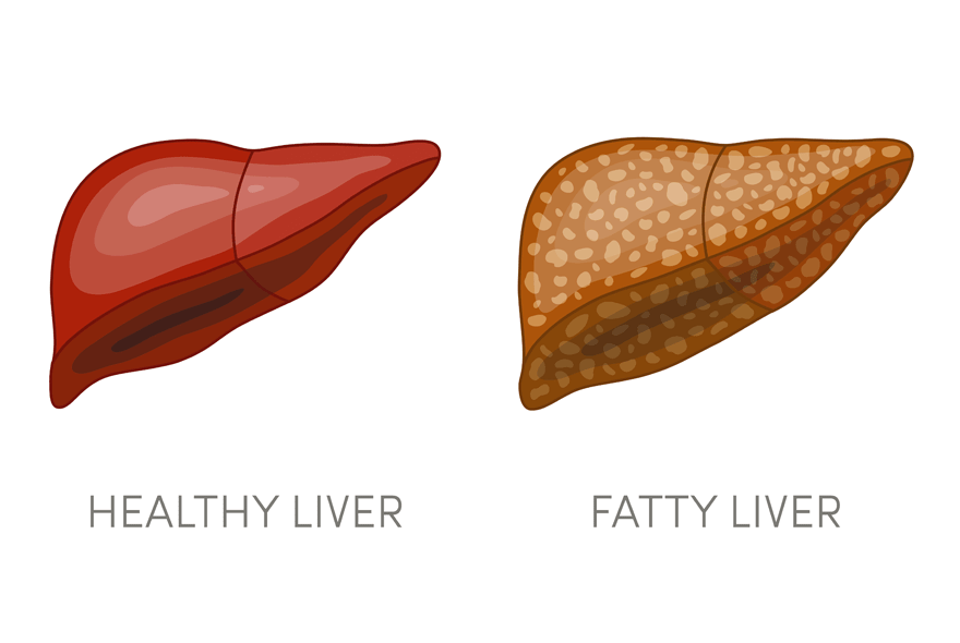All About Fatty Liver